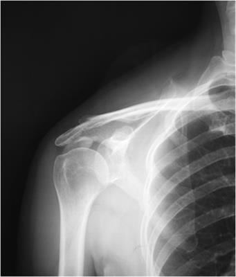 Combined arthroscopic rotator cuff repair leads to better clinical outcomes than isolated removal of calcific deposits for shoulder calcific tendinitis: A 2- to 5-year follow-up study